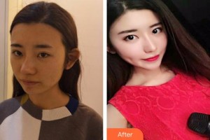 河北省中醫(yī)院醫(yī)療美容科毛俊濤整形價格表附肋軟骨隆鼻案例展示