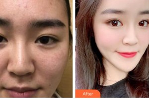 石家莊市中心醫(yī)院整形美容科雷云霄整形價格表附去痘印痘坑案例展示