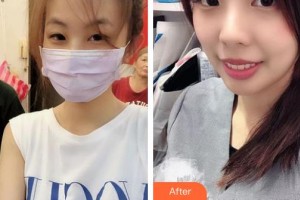 石家莊第一醫(yī)院整形科孫衛(wèi)海整形價格表附光子嫩膚案例展示