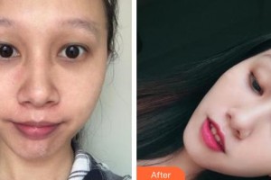 石家莊雅芳亞醫(yī)療美容醫(yī)院丁慶豐整形價格表附光子嫩膚案例展示