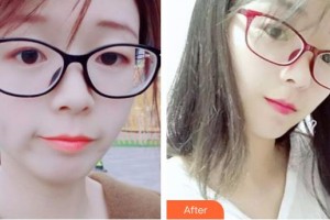 石家莊第一醫(yī)院整形科陳潮整形價格表附水氧活膚案例展示