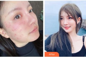 石家莊巍名仕醫(yī)療美容醫(yī)院何靜整形價格表附激光祛斑案例展示