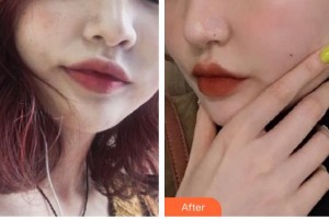 石家莊星源美天醫(yī)療美容醫(yī)院翟紅宇整形價格表附微針美膚案例展示