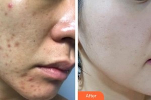 石家莊第一醫(yī)院整形科高慧整形價格表附激光點痣案例展示