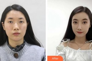 石家莊星源美天醫(yī)療美容醫(yī)院牛曉露整形價格表附假體隆鼻案例展示