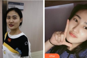 石家莊星源美天醫(yī)療美容醫(yī)院田躍華整形價格表附鼻部綜合案例展示