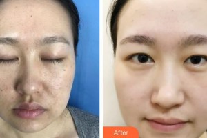 石家莊專家團醫(yī)院胎記色斑診療中心王玉國整形價格表附激光點痣案例展示