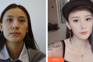 石家莊雅馨醫(yī)療美容診所張錦峰整形價格表附鼻部綜合案例展示