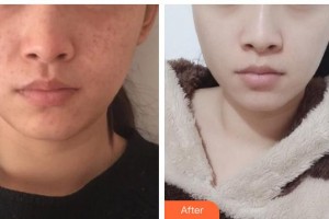 石家莊專家團醫(yī)院胎記色斑診療中心齊麗整形價格表附清潔祛痘案例展示