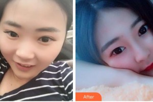 石家莊專家團醫(yī)院胎記色斑診療中心丁振華整形價格表附紅藍光祛痘案例展示