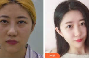 石家莊美萊醫(yī)學美容醫(yī)院李海霞整形價格表附激光去眼袋案例展示