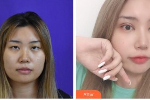 石家莊冀美醫(yī)療美容門診部戚榮整形價格表附切開雙眼皮案例展示