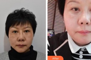 石家莊雅芳亞醫(yī)療美容醫(yī)院賈美樂整形價格表附激光去眼袋案例展示