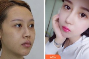 石家莊冀美醫(yī)療美容門診部李娜整形價格表附微針水光案例展示