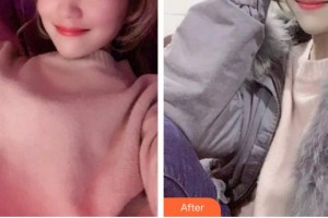 石家莊美萊醫(yī)學美容醫(yī)院張少民整形價格表附金屬托槽矯正案例展示