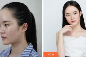 石家莊貴美人醫(yī)療美容醫(yī)院耿莉娟整形價格表附假體隆鼻例展示