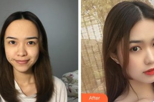 石家莊雍禾植發(fā)醫(yī)院韓巖整形價格表附種植發(fā)際線案例展示