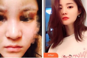 石家莊越然醫(yī)療美容門診部魏寧整形價格表附肋軟骨隆鼻案例展示