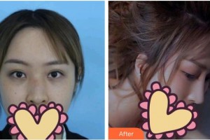 石家莊壹零壹華擎醫(yī)療美容醫(yī)院唐麗金整形價格表附鼻部綜合案例展示