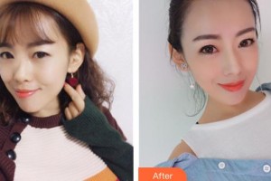 石家莊美萊醫(yī)學(xué)美容醫(yī)院田建輝整形價格表附假體隆鼻案例展示