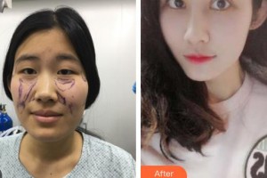 石家莊美萊醫(yī)學(xué)美容醫(yī)院姜濤整形價格表附鼻部綜合案例展示