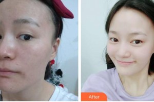 石家莊美萊醫(yī)學(xué)美容醫(yī)院王亮整形價格表附去痘印痘坑案例展示