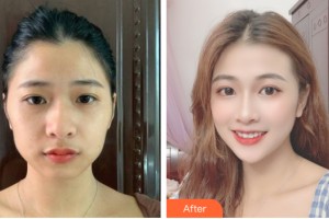 武漢媄妲醫(yī)療美容門診部何展宏整形價格表附自體脂肪填充案例展示