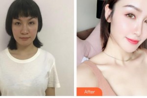 石家莊俏之翼醫(yī)療美容門診部林東勛整形價格表附鼻部綜合案例展示