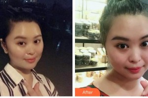 石家莊美萊醫(yī)學美容醫(yī)院石娟娟整形價格表附紅藍光祛痘案例展示