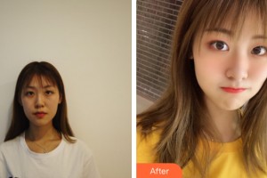 武漢米蘭醫(yī)療美容門診部柳再億整形價格表附眼部手術(shù)案例展示