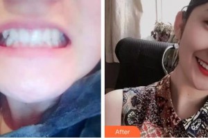 石家莊雅芳亞醫(yī)療美容醫(yī)院程維紅整形價格表附牙齒陶瓷矯正案例展示