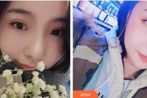 黑龍江省人民醫(yī)院整形美容中心王鑫整形價格表附牙齒隱形矯正案例展示