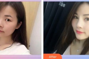 黑龍江中醫(yī)藥大學(xué)附屬第一醫(yī)院眼科劉靜霞整形價格表附切開雙眼皮案例展示