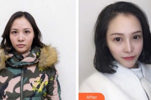 石家莊愛瑞爾醫(yī)療美容診所陳月整形價格表附眼部綜合案例展示