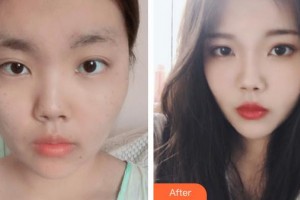 石家莊倩仕醫(yī)療整形美容門診部李娟整形價格表附光子嫩膚案例展示