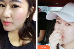 石家莊市婦產醫(yī)院醫(yī)療整形美容科高慧整形價格表附清潔祛痘案例展示