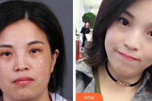 石家莊匯美天成醫(yī)療美容門診部王麗整形價格表附激光祛斑案例展示