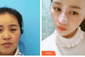 石家莊匯美天成醫(yī)療美容門診部翟彥剛整形價格表附鼻部綜合案例展示