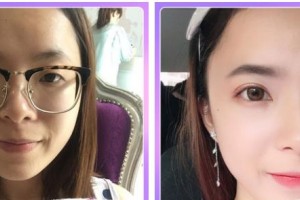 石家莊康體醫(yī)療美容門診部孫衛(wèi)海整形價格表附埋線雙眼皮案例展示