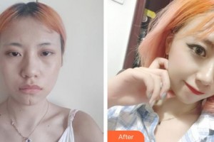 唐山惠美登醫(yī)療美容醫(yī)院劉彤整形價格表附激光祛疤案例展示