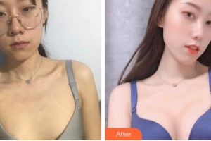 唐山金鳳凰美容整形醫(yī)院宋美璇整形價格表附自體脂肪隆胸案例展示