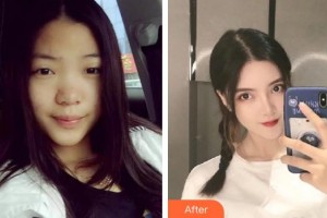 唐山煤醫(yī)整形美容醫(yī)院金明徹整形價格表附鼻部綜合案例展示