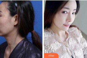 唐山金鳳凰美容整形醫(yī)院李春鵬整形價格表附鼻修復案例展示