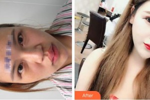 唐山煤醫(yī)整形美容醫(yī)院徐萬群整形價格表附假體隆鼻案例展示