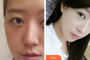 唐山開灤醫(yī)院整形美容中心趙紹明整形價格表附鼻部綜合案例展示