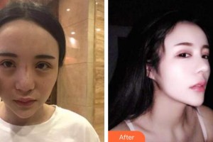唐山煤醫(yī)整形美容醫(yī)院尹賢哲整形價格表附鼻部綜合案例展示