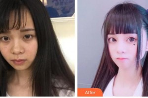 唐山煤醫(yī)整形美容醫(yī)院崔弘林整形價格表附切開雙眼皮案例展示