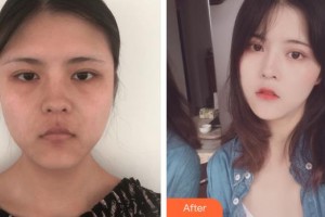 唐山金榮整形美容醫(yī)院劉雙飛整形價格表附埋線提升案例展示