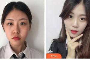 唐山煤醫(yī)整形美容醫(yī)院黃鎔碩整形價格表附埋線提升案例展示