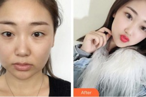 唐山灤縣人民醫(yī)院美容整形科齊向梅整形價格表附埋線提升案例展示